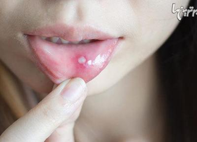 چه زمانی آفت دهان خطرناک می گردد؟ چه زمانی آفت دهان خطرناک می گردد؟